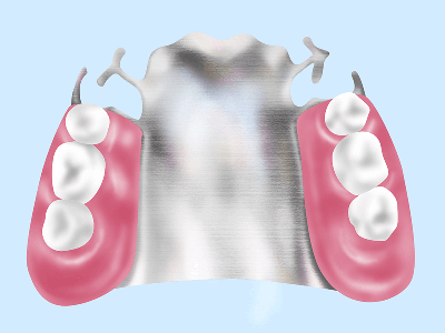 金属床義歯（自費診療）