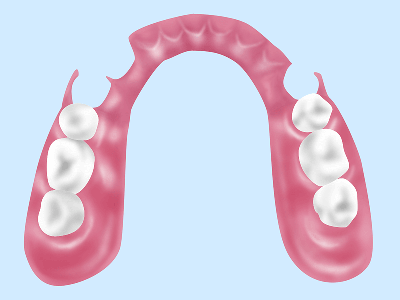 ノンクラスプデンチャー（自費診療）