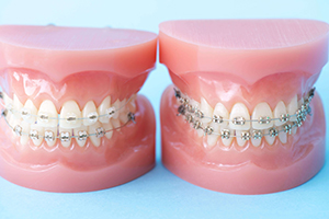 歯並びの乱れが体調に悪影響を与えます