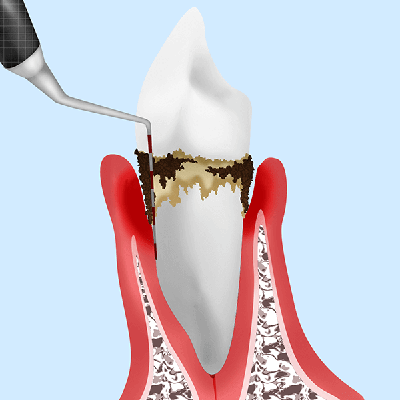 気づかないうちに進行しています～歯周病～