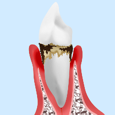 重度の歯周炎